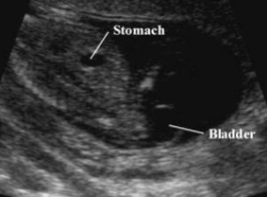 <p>What pathology is seen here?</p>