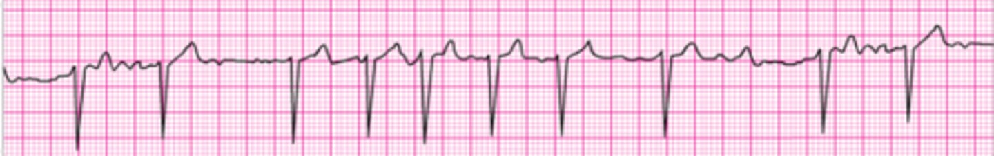 <p>Identify the rhythm.</p>