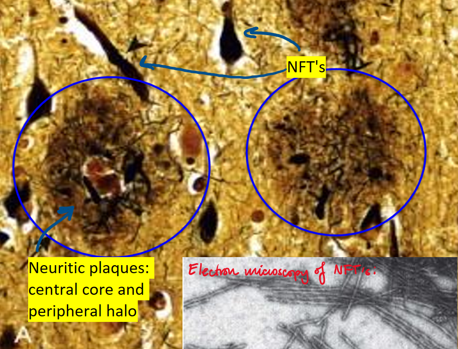 <p><u>Signs</u>:</p><ul><li><p>Short-term memory loss</p></li><li><p>Impairment of visuospatial skills</p></li><li><p>Disorientation, word-finding difficulty</p></li><li><p>Ultmate loss of mobility and speech</p></li><li><p>Diffuse cerebral atrophy</p></li><li><p>Biopsy shows NFT’s and neuritic plaques</p></li></ul><p></p><p><u>Pathogenesis</u>: extrcellular deposition of AB peptides which aggregate to form amyloid fibrils. These cause neuronal injury and dysfunction, and stimulate an inflammatory response causing neuronal damage and phosphorylation → aggregation of tau proteins</p><ul><li><p>Sporadic, late-onset AD: ApoE gene on chr 19</p></li><li><p>FAD: APP, PSEN1/PSEN2 gene</p></li></ul><p></p>