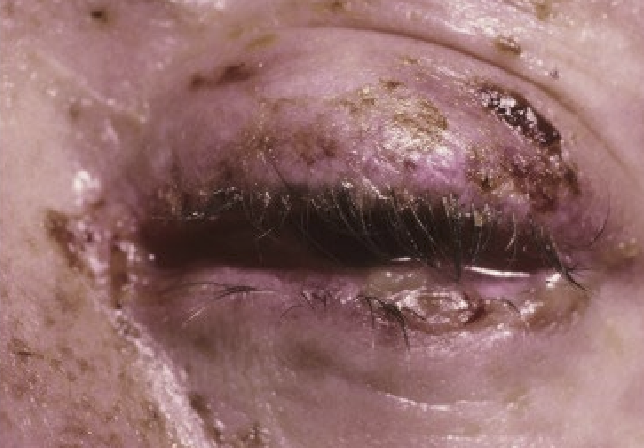 <p>An autoimmune reaction that causes painful rash&nbsp;and blistering of the skin and mucous membranes.  Less than 5000 individuals in US have been diagnosed. </p>