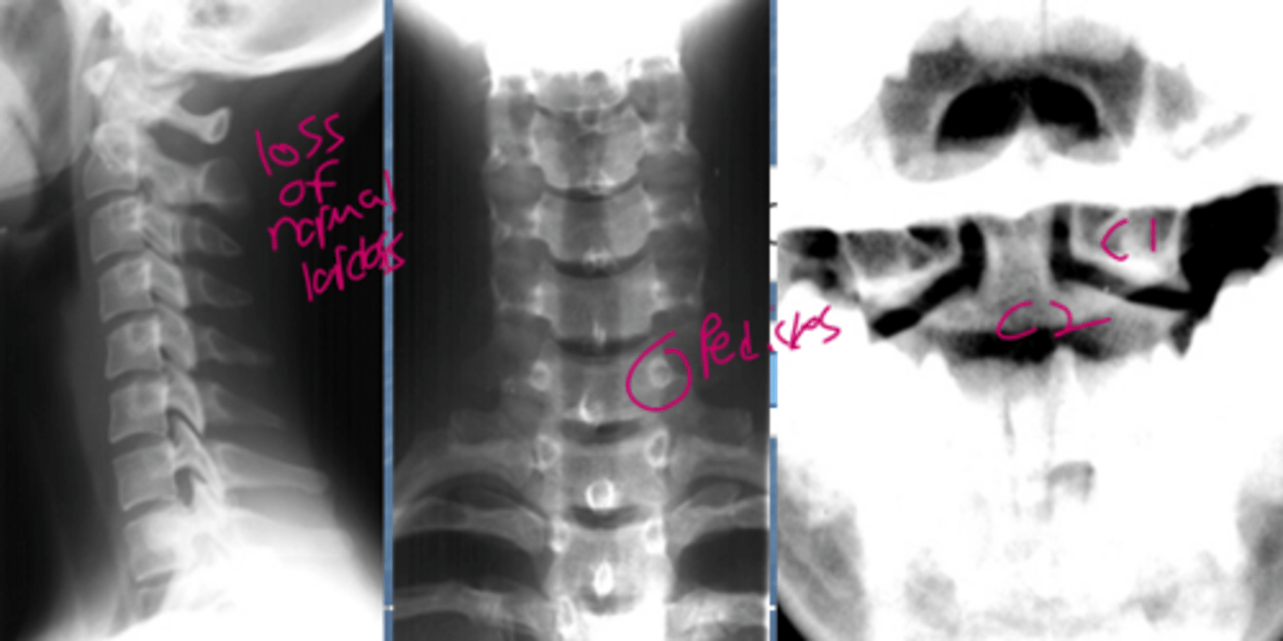 <p>1.C1 and C2 for any widening (atlantoaxial joint >3 mm)</p><p>2.First look at the anterior vertebral line then go down the list.</p><p>3.I want to see the top of T1 if I can</p>