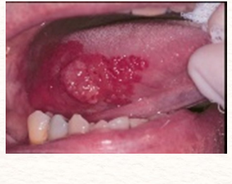 <p><strong>Symptoms and Treatment of Oral Squamous Cell Carcinoma</strong></p><p>-Red (erythroplakia), white (leukoplakia), or mix of both (erythroleukoplakia) sometimes with an _______</p><p>-Location: ________ border of the tongue, oropharynx, and ______ of mouth</p><p>-Most, if &lt; 2 cm are cured by local _______. __________ is alternative treatment but generally not used as 1st line for small lesions</p><p>-Any single ulcerated lesion persisting for more than 3 weeks should be sent for ________</p>