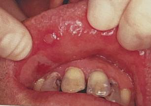 <ul><li><p>Identify the disease</p></li><li><p>Course of pemphigus vulgaris is variable</p></li></ul><p></p>