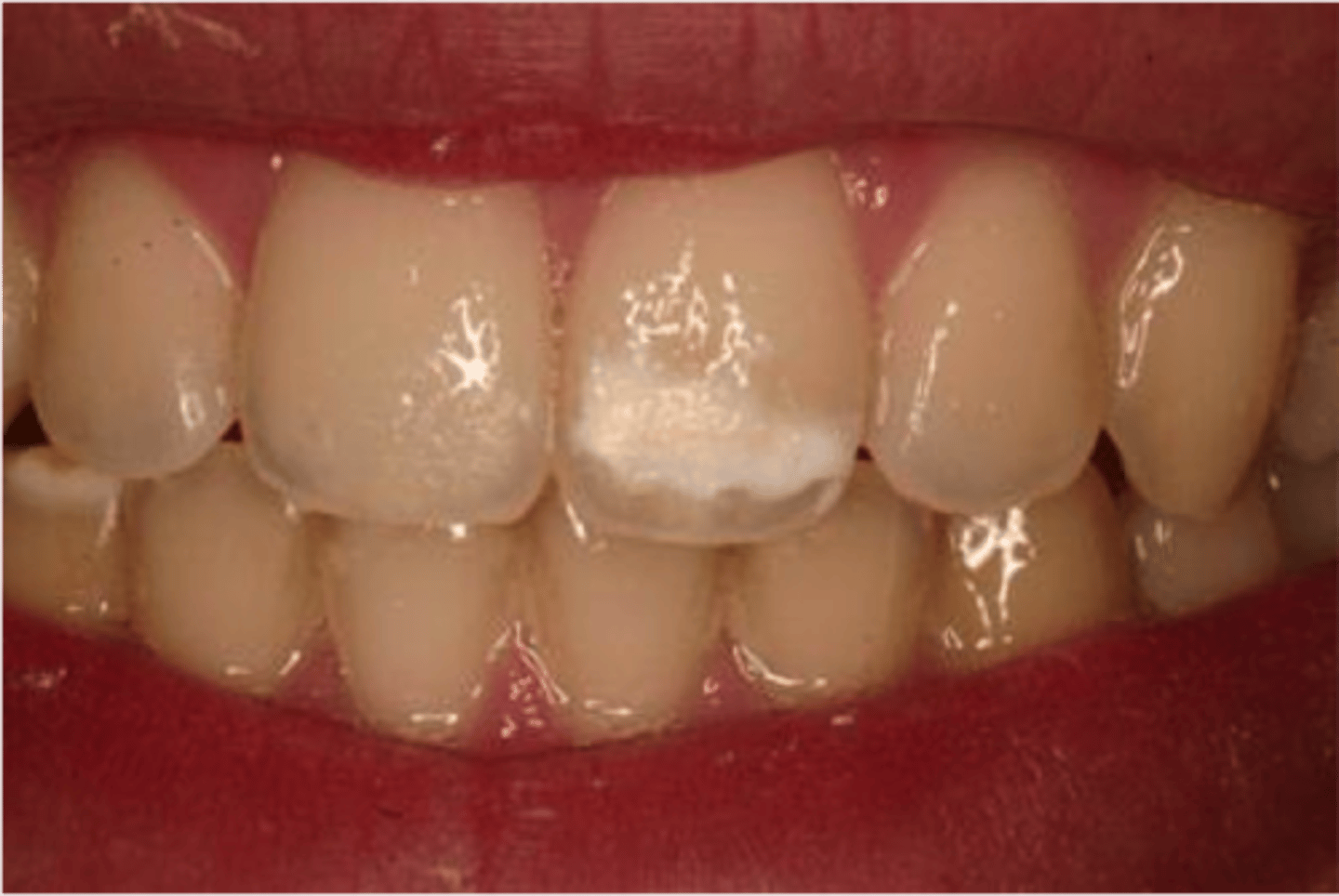 <p>- systemic-chronologic; ameloblastic disturbance of short duration<br>- Local affects, usually a single tooth</p>