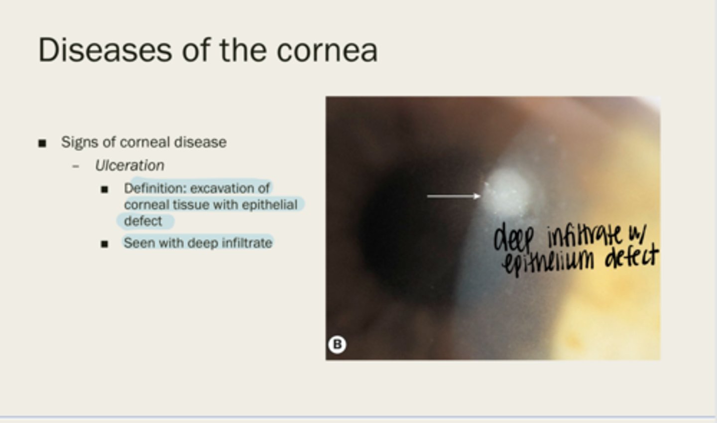 <p>excavation of corneal tissue with epithelial defect</p>