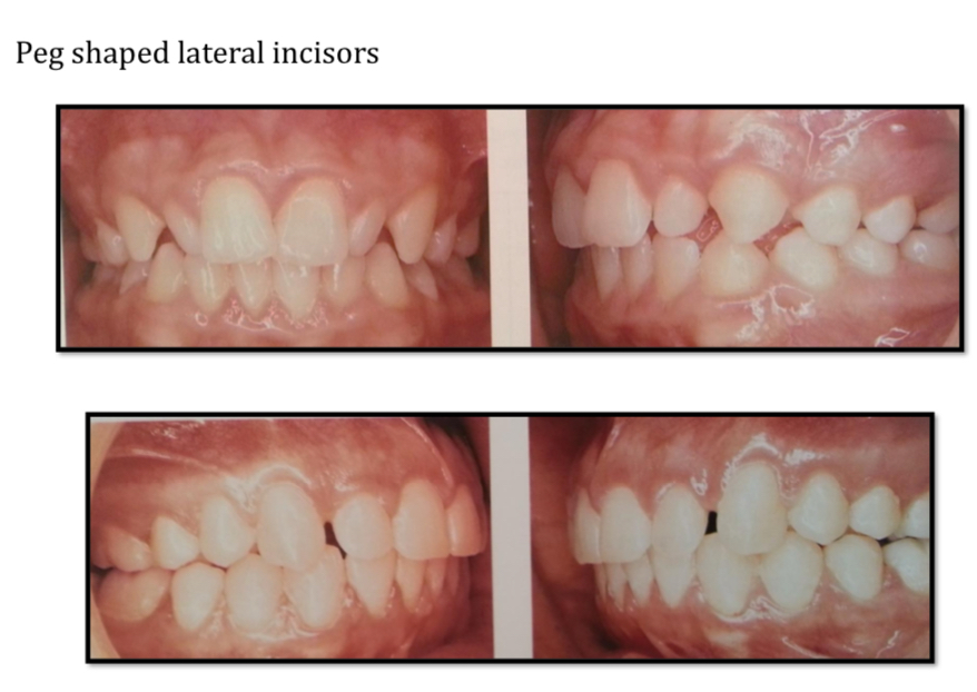 <p>Both alterations of Bolton index</p><p>Open space and reconstruct with filling, crown or veneer</p><p>Interproximal reduction</p><p>Need to achieve desirable intercuspation and class 1 canine</p>