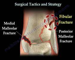 occurs at ankle and affects both medial and lateral part of the bone