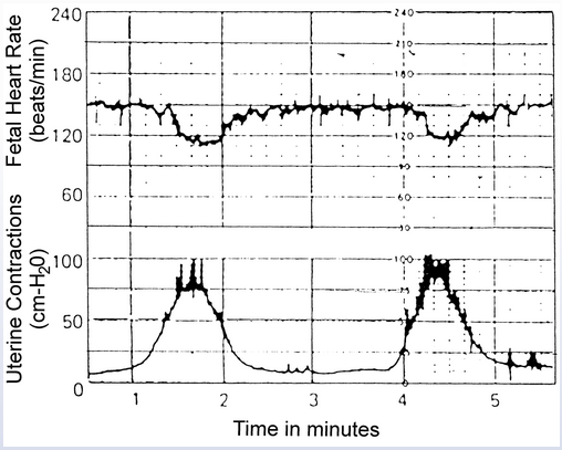 <p>39wks, contractions, progressive cer dialation. what does this show?</p>
