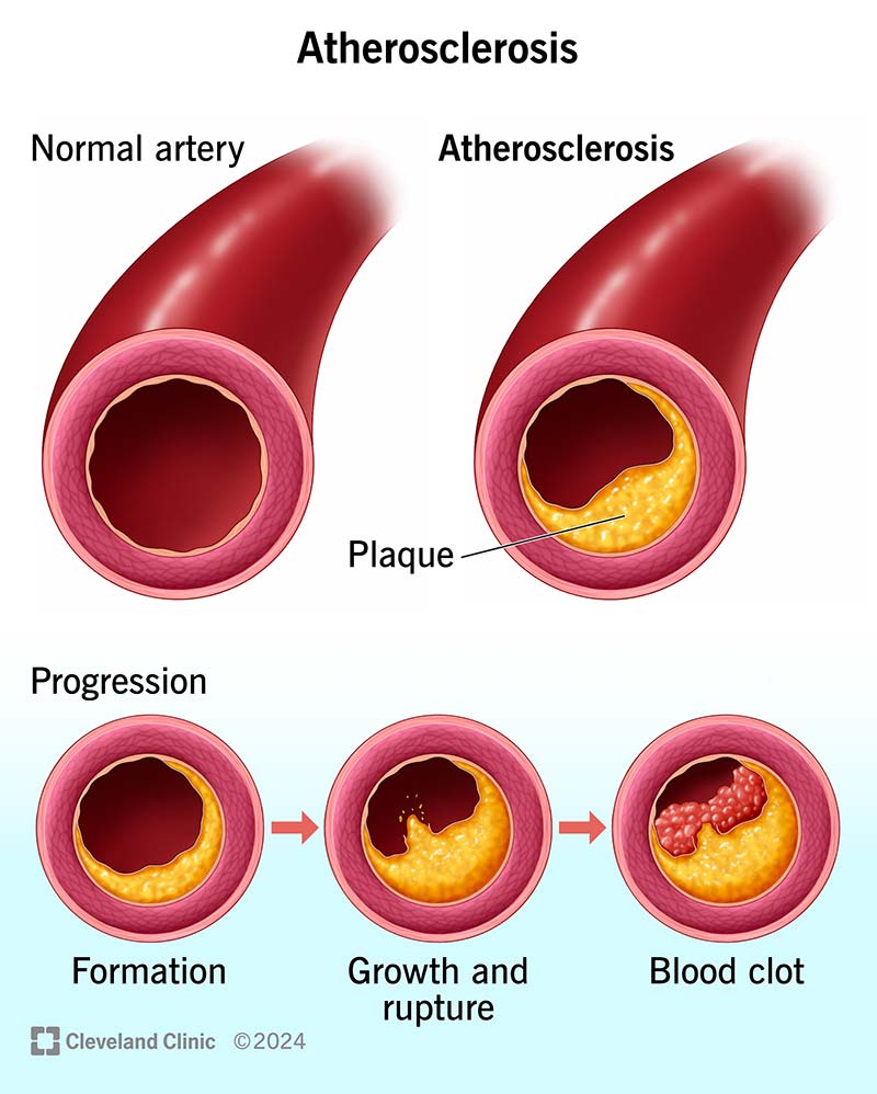 <p>ACS typically results from the<strong> rupture of an atherosclerotic plaque and subsequent thrombus formation, </strong>leading to a <strong>sudden reduction or blockage of blood flow in a coronary artery.</strong></p><p>The rupture of an atherosclerotic plaque exposes the underlying tissue to blood, <strong>causing platelet activation and aggregation, leading to thrombus formation.</strong></p>