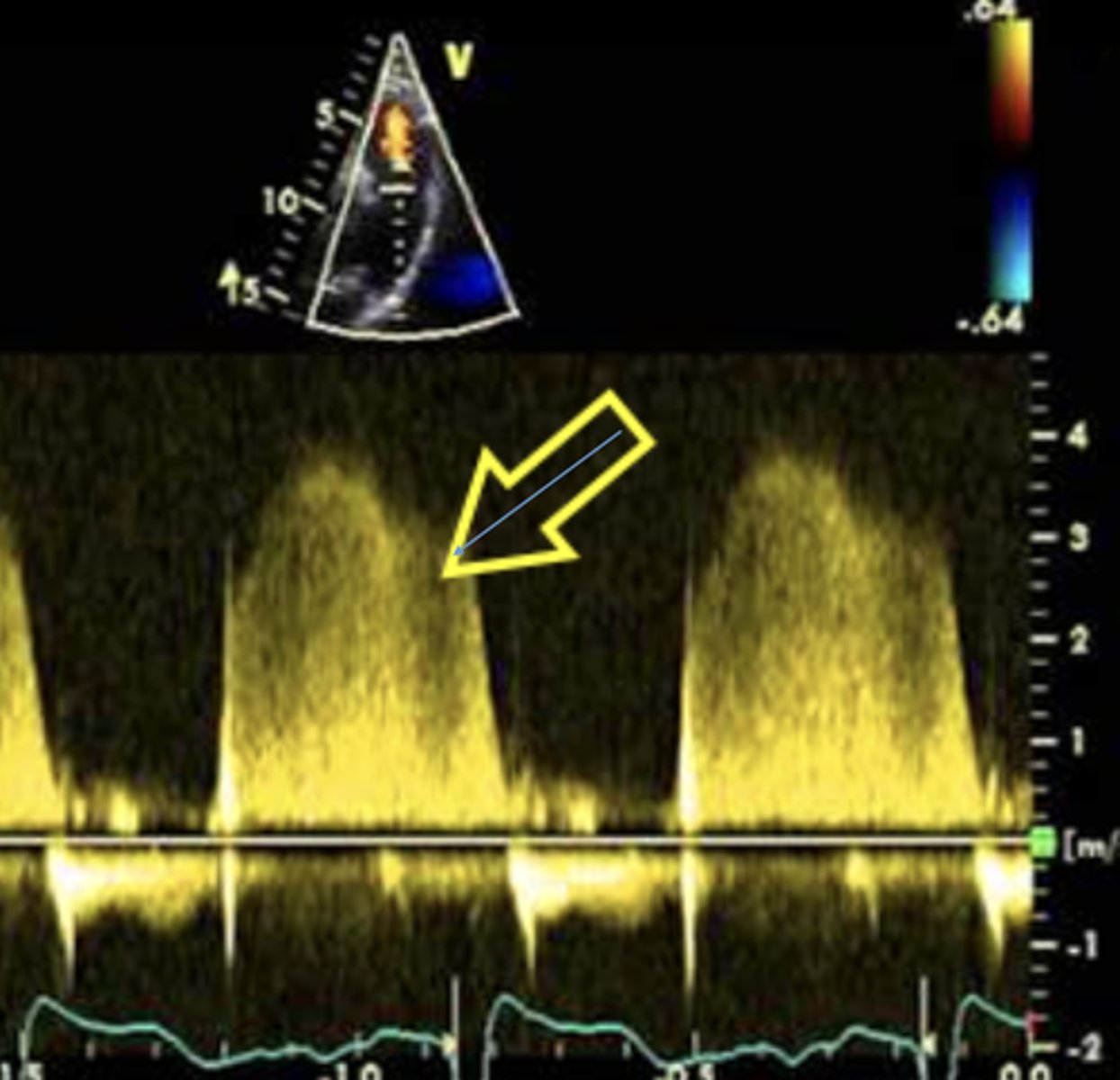 <p>Brighter/denser signal</p><p>Rapid deceleration</p>