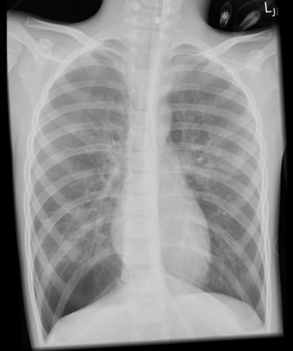 <p>Patient presents with wheezing, SOB, chest tightness, cough, episodic symptoms worse at night or early in the morning, known atopic disorder</p><p>Exam:</p><p>widespread wheezing on auscultation</p><p>blood test: serum eosinophil count, IgE, allergen skin prick tests</p>