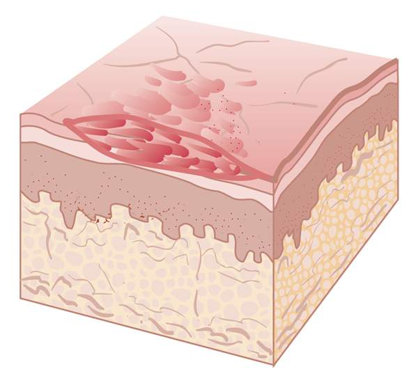 <p>flaking layers of epidermis</p>