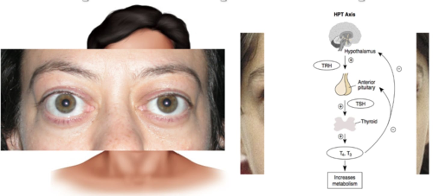 <p>TSH receptor stimulation by immunoglobulin G</p><p>Excessive T3 and T4 production</p><p>Protruding eyeballs exophthalmos</p>