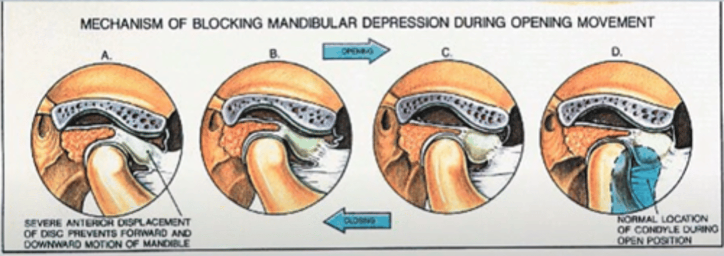 <p>= anteriorly displaced disk (= stuck) </p><p>- limited ROM (blocked by the disk) </p><p>+</p><p>- pain (loading on improper area of the disk)</p>