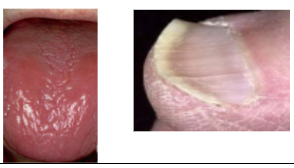 <p><span style="background-color: transparent; font-family: "Times New Roman", serif;"><u>SYSTEMIC</u>:</span></p><p><span style="background-color: transparent; font-family: "Times New Roman", serif;">*Fatigue, lightheadedness, lack of energy</span></p><p><span style="background-color: transparent; font-family: "Times New Roman", serif;">*Skin pallor</span></p><p><span style="background-color: transparent; font-family: "Times New Roman", serif;">*Atrophy of gastric mucosa</span></p><p><span style="background-color: transparent; font-family: "Times New Roman", serif;">*Alopecia</span></p><p><span style="background-color: transparent; font-family: "Times New Roman", serif;">*<strong>Koilonychia </strong>(spoon-shaped nails)</span></p><p><span style="background-color: transparent; font-family: "Times New Roman", serif;">*<strong>Restless Leg Syndrome</strong></span></p><p><span style="background-color: transparent; font-family: "Times New Roman", serif;">*<strong>Pica</strong> (consumption of non-food based items)</span></p><p></p><p><span style="background-color: transparent; font-family: "Times New Roman", serif;"><u>ORAL</u>:</span></p><p><span style="background-color: transparent; font-family: "Times New Roman", serif;">*<strong>Atrophic glossitis +/- burning sensation</strong></span></p><p><span style="background-color: transparent; font-family: "Times New Roman", serif;">*<strong>Generalized mucosal atrophy</strong></span></p><p><span style="background-color: transparent; font-family: "Times New Roman", serif;">*<strong>Gingival pallor</strong></span></p><p><span style="background-color: transparent; font-family: "Times New Roman", serif;">*<strong>Angular cheilitis</strong> (may predispose to candidiasis)</span></p>