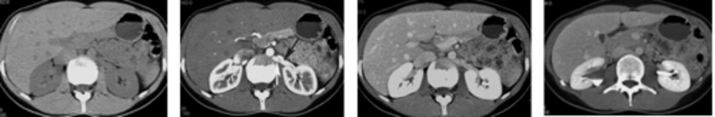 <p>Túbulos colectores → Papila renal → Cálices menores → Cálices mayores → Pelvis renal → Uréter → Vejiga → Uretra.</p>
