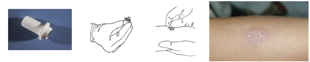 <p>multiple puncture tuberculin skin test. uses small button that has 4-6 short needles coated with tuberculin. pressed into skin, forcing antigens into skin. measure size of palpable induration. negative result: no papules. positive test should be verified using Mantoux test</p>