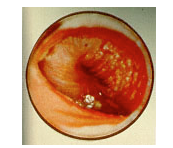 <p>acute otitis media</p>