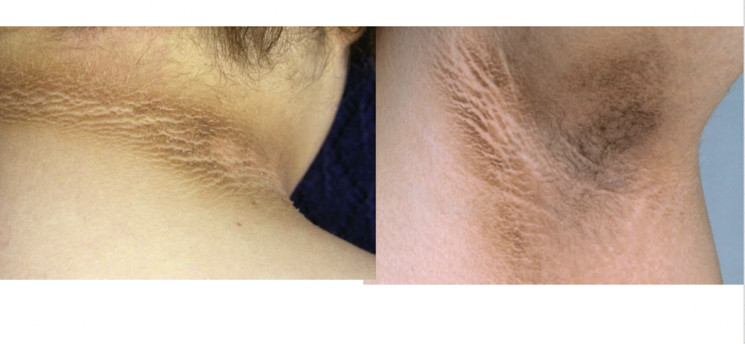 <p>hyperkeratosis and pigmentation of axilla, neck, flexures, and anogenital region</p>
