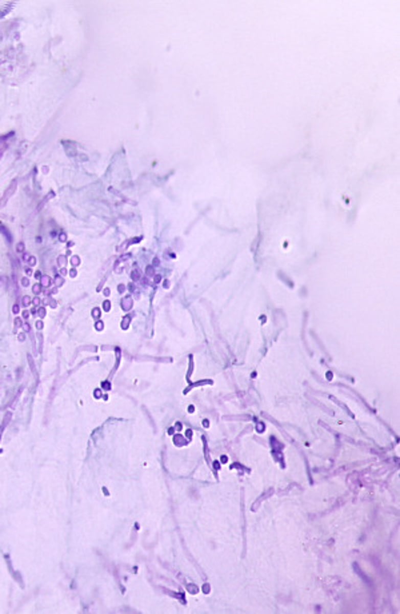 <p>Malassezia furfur is most often diagnosed from direct examination. Infected skin scrapings show fungal elements with a characteristic "spaghetti and meatball" appearance.</p>