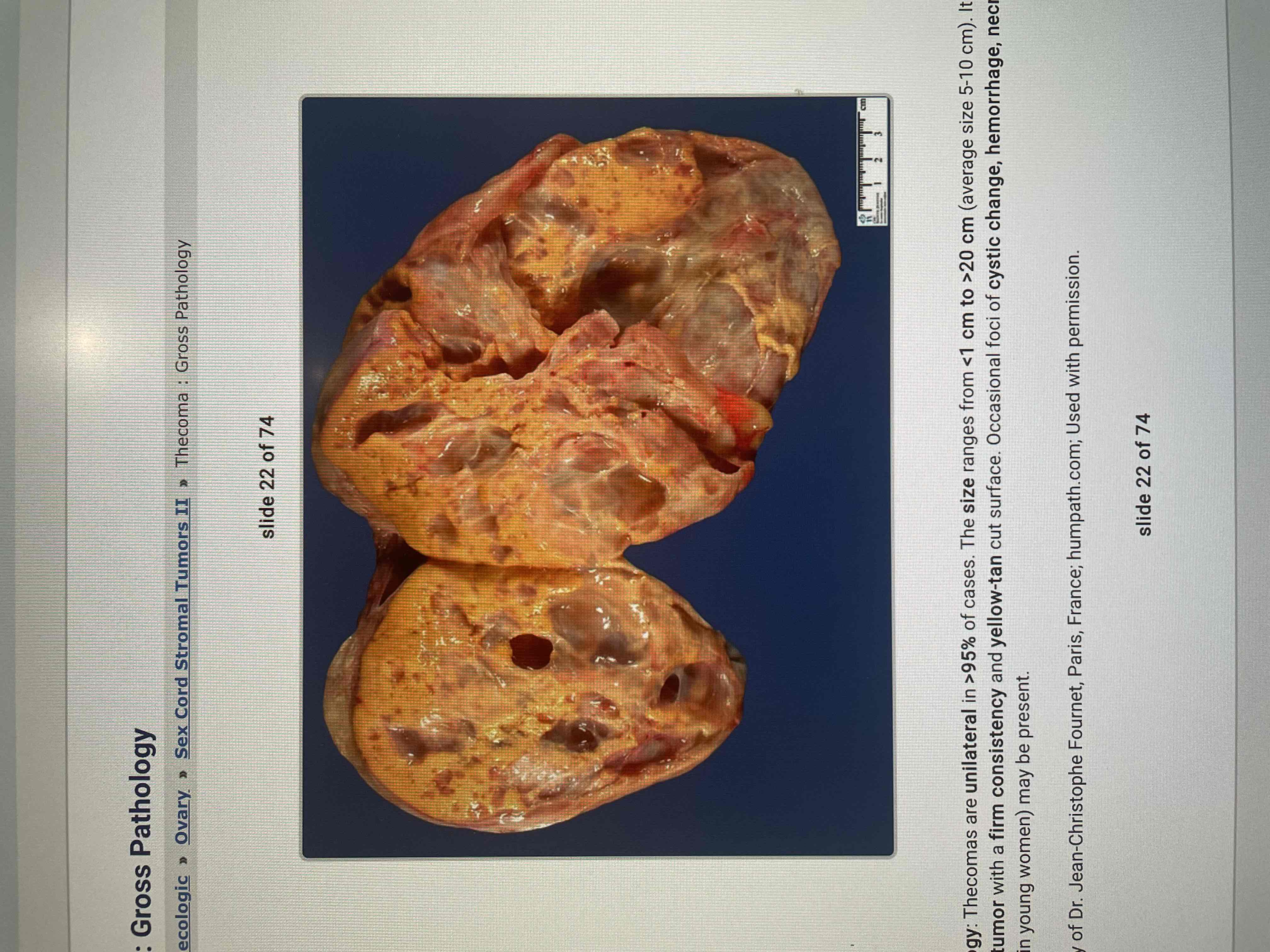<p>Ovarian tumour - yellow cut suface - what’s this tumour?</p>