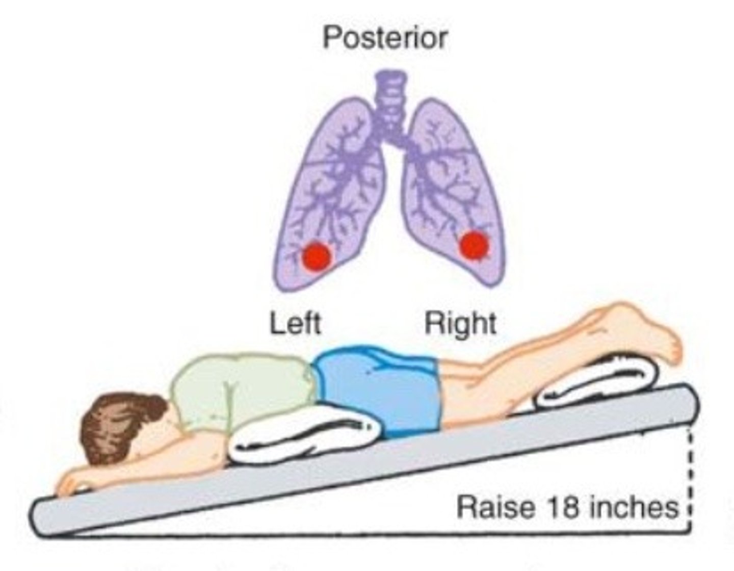 <p>- Position the patient prone with the foot of the bed elevated 18 - 20 inches.</p><p>- Area to percuss is over the lower ribs.</p>