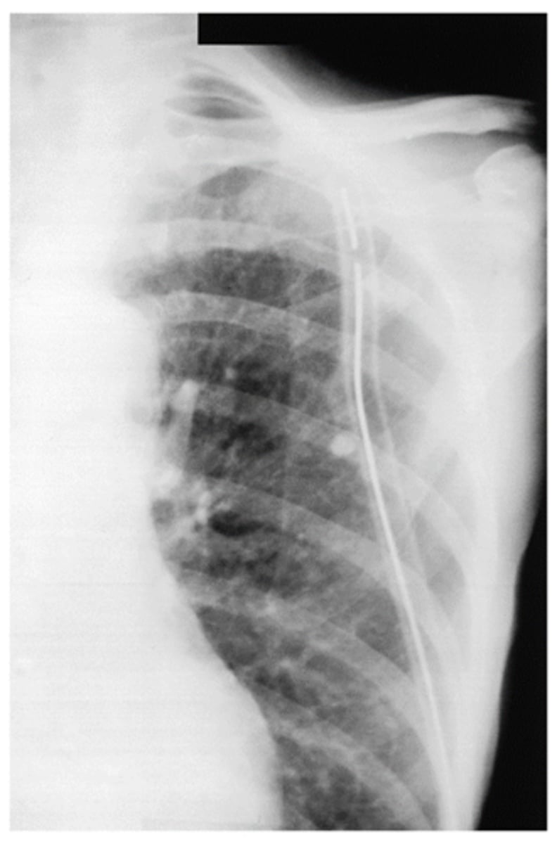 <p>What is goin going on in this CXR?</p>