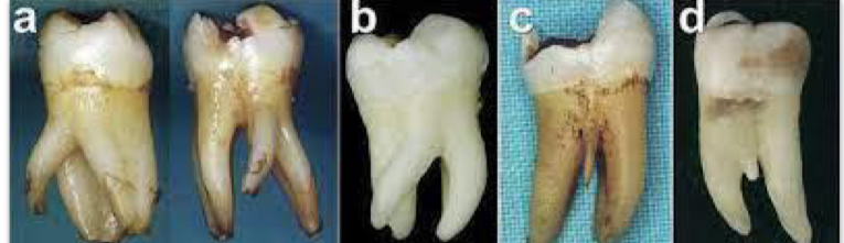<p>3 roots- extra one called radix entomolaris&nbsp;</p>
