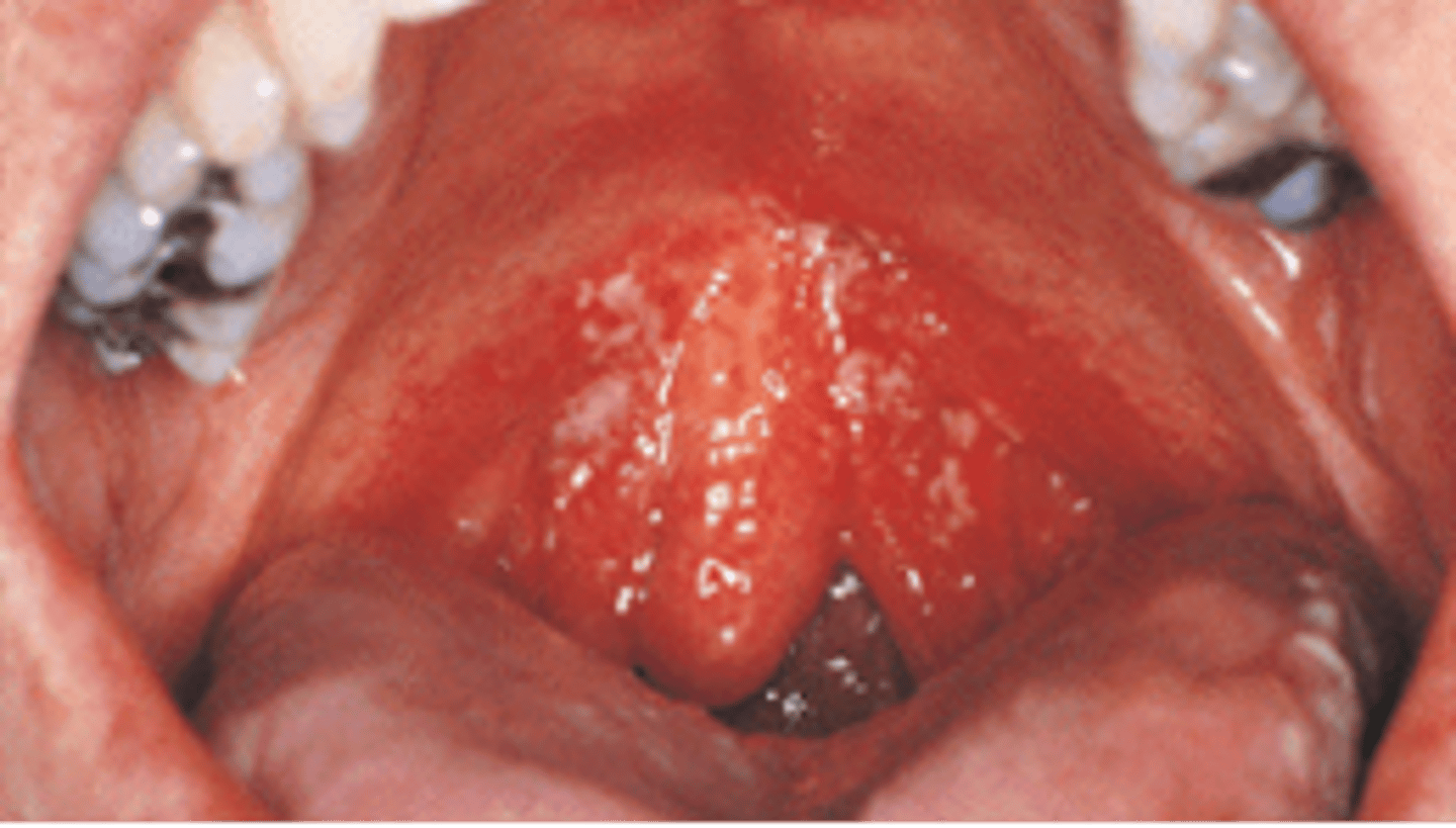 <p>Candidiasis (Thrush)</p>