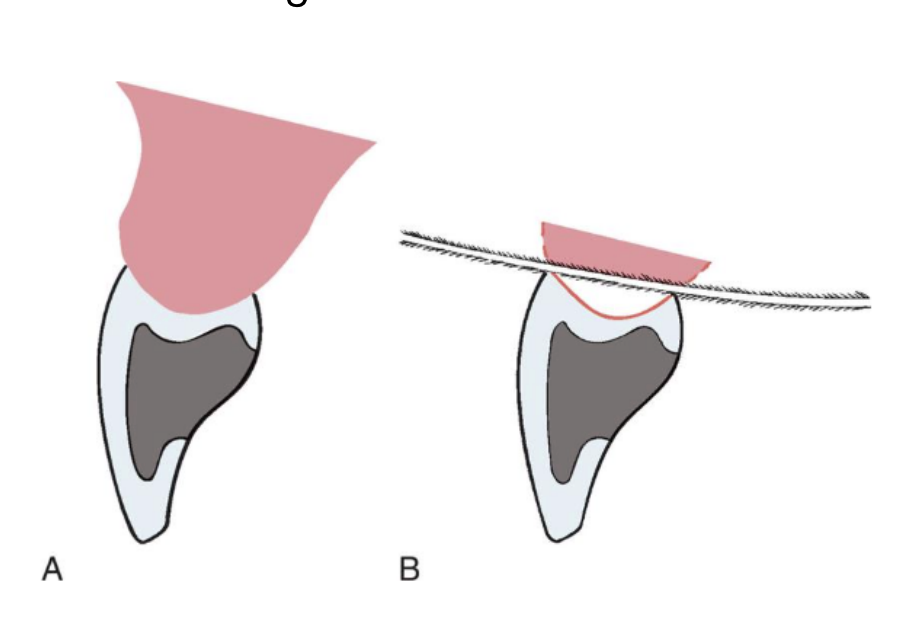 <p>saddle or ridge-lap designs </p>