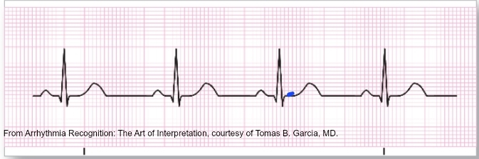 <ul><li><p>Complexes and morphology the same as NSR, only the rate differs</p></li><li><p class="is-empty is-editor-empty has-focus">Rate of less than 60 beats/minute</p></li><li><p class="is-empty is-editor-empty has-focus">Rhythm is regular.</p></li><li><p class="is-empty is-editor-empty has-focus">Treatment focuses on the patientâs tolerance to the bradycardia</p></li></ul><p></p>