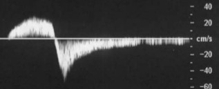 <ol><li><p>Does this waveform appear normal or abnormal?</p></li><li><p>If abnormal, what about the waveform indicates that?</p></li><li><p>If abnormal, what pathology could this waveform be an indication of?</p></li></ol><p></p>