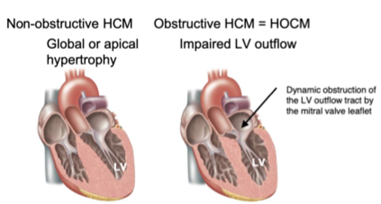 <p>Similar to hypertrophic cardiomyopathy, but in this case there is a blockage of the LV outflow tract leading to ↓ peripheral perfusion; often as syncope, but may present as chest pain or sudden death as well</p>