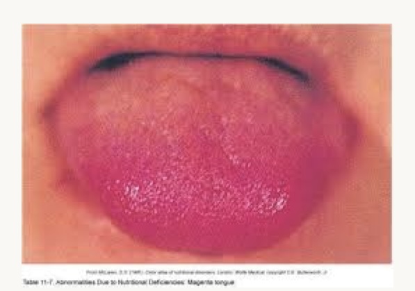 <p>what is this condition and what vitamins is this person likely deficient in?</p>