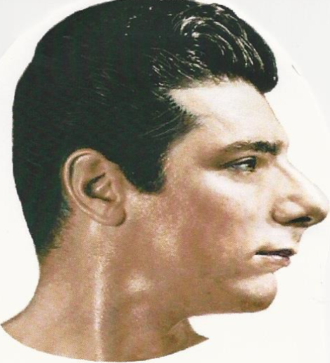 <p><span>Receding forehead; Receding Chin</span></p>