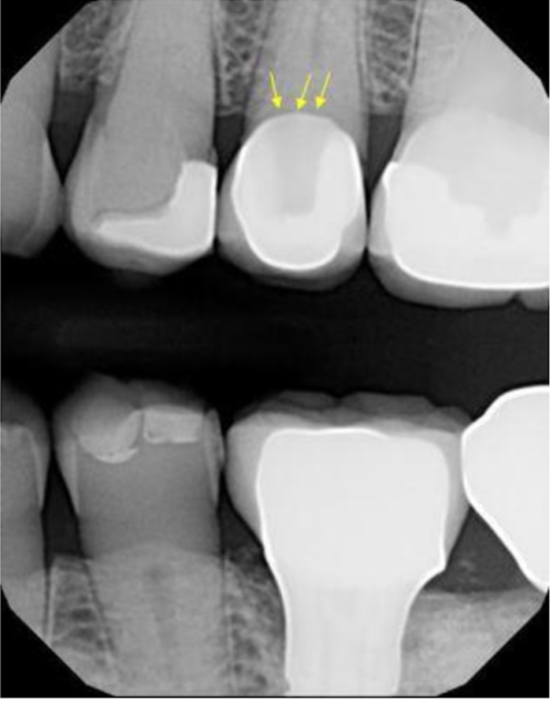 <p>cause of this thin dark line at the root of #13</p>