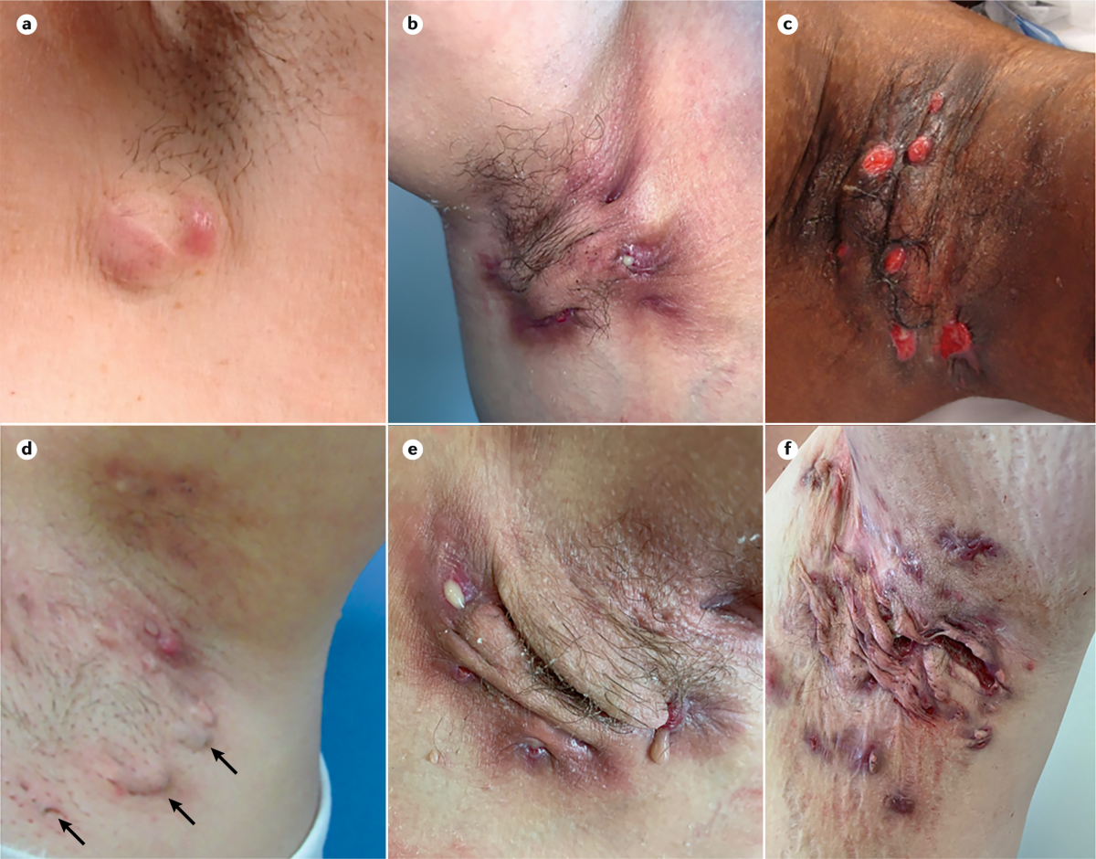 <p>E: chronic<br>puberty<br>apocrine gland sites<br>-axillae<br>-groin</p><p>CM: tender+recurrent inflammatory nodules/abscesses<br>open comedomes<br>sinus tracts<br>purulent drainage</p><p>DX: bx culture</p><p>TX:<br>NP:<br>decrease weight<br>stop smoking<br>incision+drainage<br>excision+laser surgery</p><p>MX:<br><strong>1st line: topical tetracycline</strong><br>chlorhexidine<br>IL triamcinolone<br>prednisone<br>humira<br>cosentyx</p>