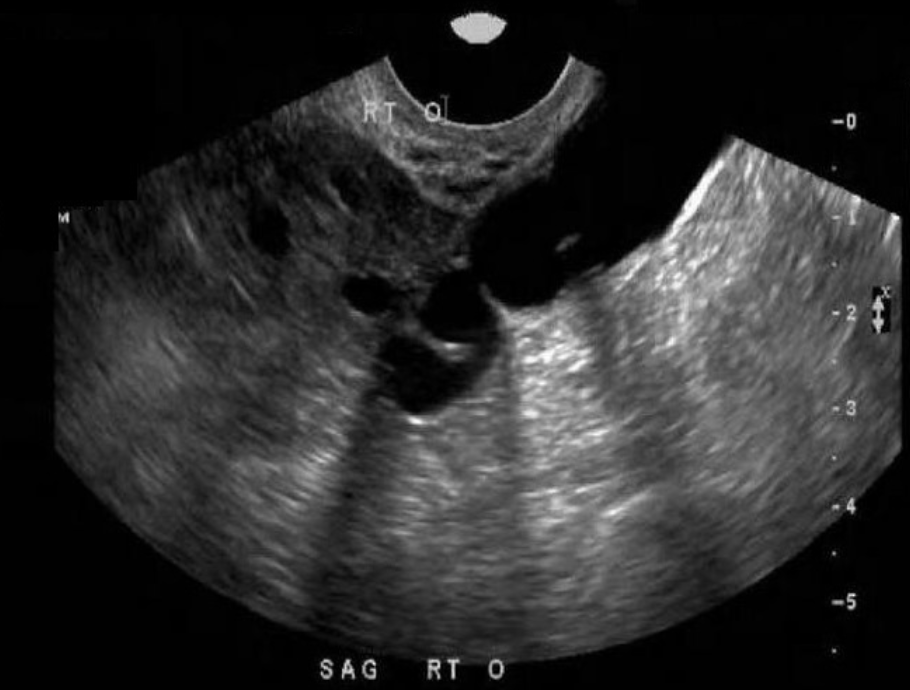 <p>26 yo w/pelvic pain + discharge for 3 weeks, LMP 3.5 weeks ago, G1, P2. lab shows leukocytosis</p><p>a) dilated pelvic veins next to ovary, can be complication for mothers of multiple births</p><p>b) dilated fallopian tube w/internal debris + nodularity consistent w/carcinoma formation</p><p>c) dilated, anechoic fallopian tube medial to the ovary, aka hydrosalpinx, consistent w/probable PID</p><p>d) dilated fallopian tube due to the presence of interstitial ectopic pregnancy </p>