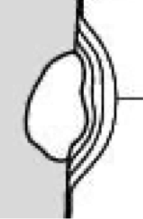 <p>what type of abnormal periosteum is this?</p>