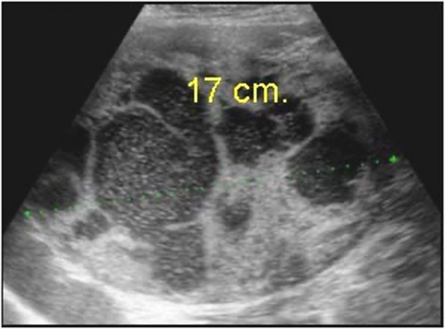 <p>What are symptoms of RCC? </p>