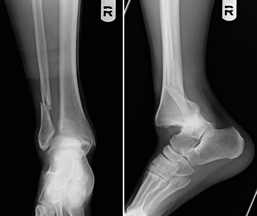 <p>Name this fracture</p>
