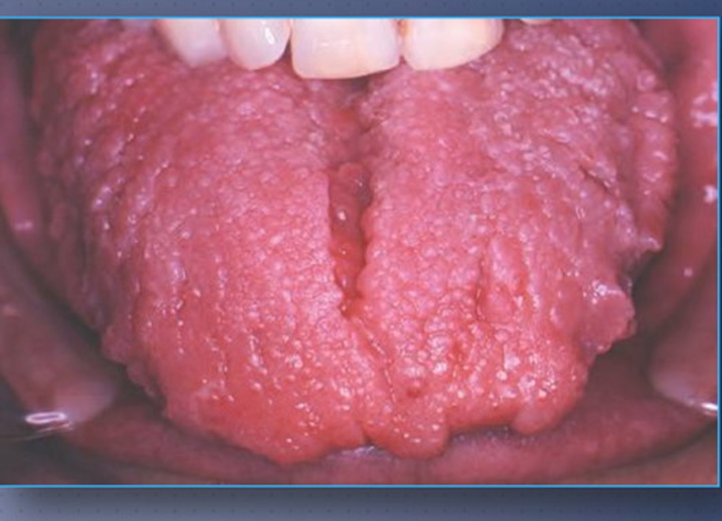 <p>• Enlargement of the tongue</p><p>• May be congenital or acquired</p><p> Common with Down syndrome </p>