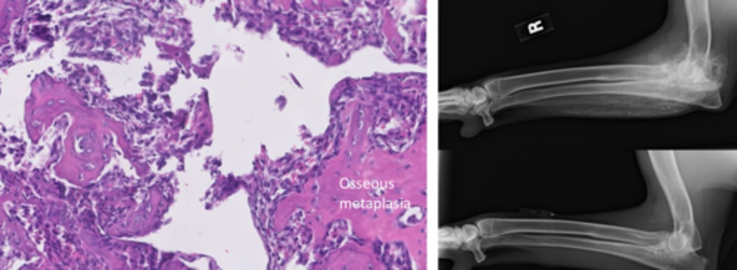 <p>What is myositis ossificans?</p>