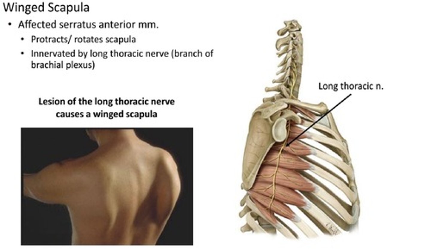 <p>Injury: lesion of the long thoracic nerve</p><p>Causes:</p><p>- axillary node dissection after mastectomy</p><p>- stab wounds</p><p>Muscle Deficit/Functional Deficit:</p><p>- serratus anterior</p><p>Presentation:</p><p>- inability to anchor scapula to the thoracic cage --> cannot abduct arm above horizontal position</p>
