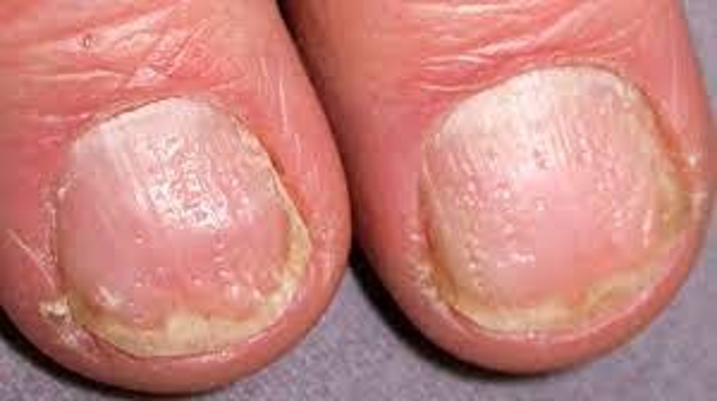 <p>Small depression on the nail surface</p><p>Causes:</p><p>-Exposure to chemicals</p>