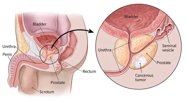 <ul><li><p>A cancer in a man's prostate, a small walnut-sized gland that produces seminal fluid that nourishes and transports sperm</p></li><li><p>Symptoms could be difficulty with urination but there are often none at all</p></li></ul>