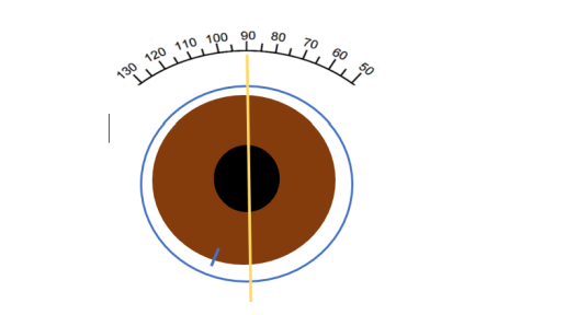<p>You are assessing the fit of a soft toric contact lens for a patient’s right eye, and you see the following lens appearance. The yellow line is for reference and is your light beam set at 90degrees. The Contact lens prescription for this eye is +1.75/-1.75 x 20 (1 mark)</p><p></p><p>How would you amend your lens selection? </p><p> Keep the same prescription +1.75/-1.75 x 20 </p><p> Amend lens prescription to +1.75/-1.75 x 70 </p><p> Amend lens prescription to +1.75/-1.75 x 110 </p><p> Amend lens prescription to +1.75/-1.75 x 40 </p><p> Amend lens prescription to +1.75/-1.75 x 180</p>