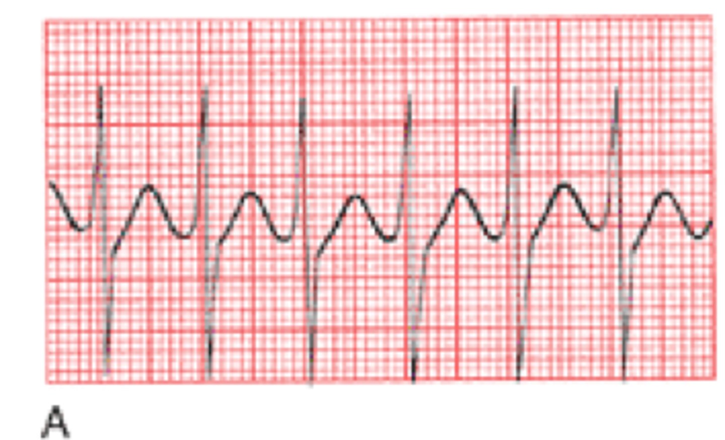 <p>cannot identify p wave and narrow QRS. rapid heartbeat that develops when the normal electrical impulses of the heart are disrupted.</p>