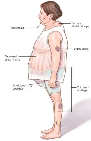 <p>● The opposite of Addison’s Disease</p><p>● When our body is always in a state, it triggers the body to produce and release too much cortisol</p><p>● The unique manifestation of cushing syndrome is Buffalo Hump wherein there is a fatty pads in the neck</p><p>● Striae or Abdominal Stretch Marks</p><p>● Pendulus Abdomen</p><p>● Bruise Easily</p><p>● Proportion of the body. In the middle part of the body, fat is concentrated compared to the arms and legs</p>