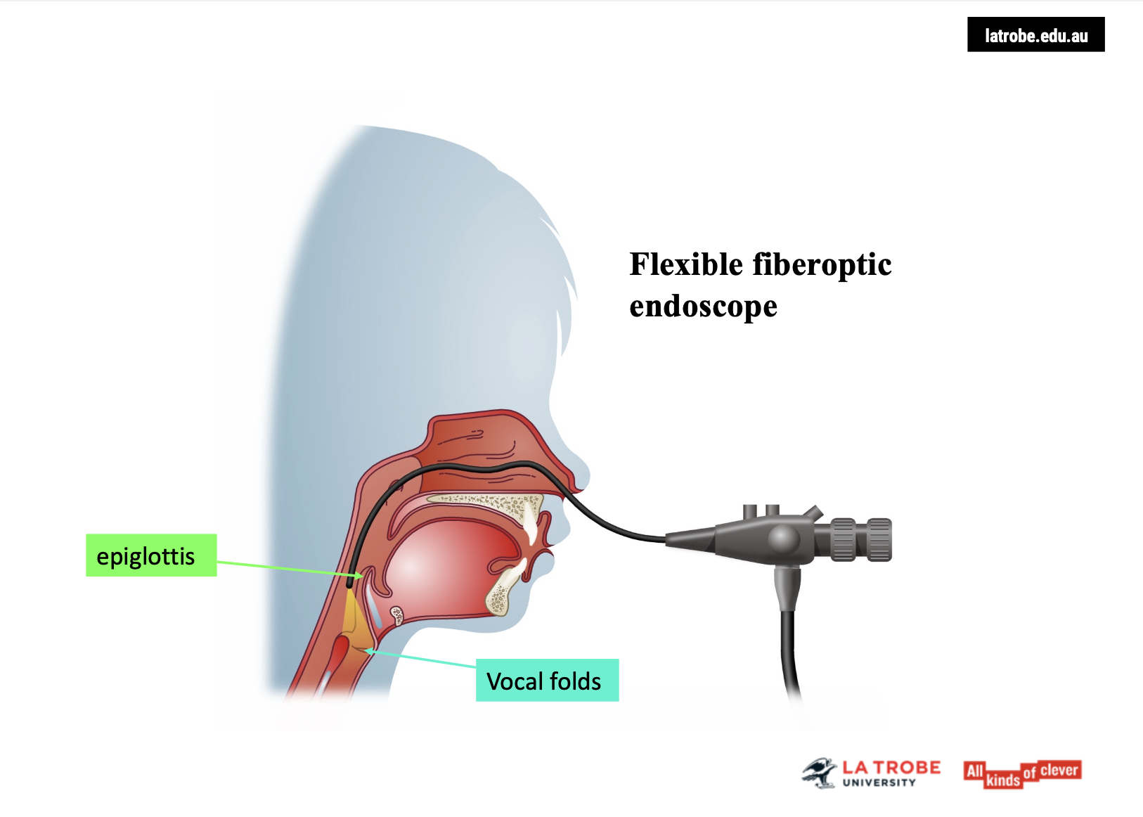 <ul><li><p><span><strong>Insertion Process</strong>: The endoscope is inserted through the <strong>nostrils</strong>, navigating across the <strong>nasal floor</strong> into the <strong>nasopharynx</strong>. It can be advanced further towards the <strong>epiglottis</strong> and even deeper into the vocal tract, such as in <strong>trans-nasal esophagoscopy</strong>.</span></p></li><li><p><span><strong>Patient Comfort</strong>: This procedure can be <strong>uncomfortable</strong> for the patient, particularly if the scope is inserted deeply.</span></p></li></ul><p>&nbsp;</p><p><span><strong>Visualisation </strong></span><span data-name="eyes" data-type="emoji">👀</span></p><ul><li><p><span><strong>View of the Larynx</strong>: The endoscope provides a <strong>bird’s-eye view</strong> of the entire <strong>laryngeal area</strong> and surrounding structures, offering valuable insight into vocal fold movement, glottal closure, and any potential abnormalities.</span></p></li></ul><p>&nbsp;</p><p>Flexible fibre optic endoscopy is an important tool for <span><strong>visualising the larynx</strong></span> and assessing <span><strong>laryngeal function</strong></span>, especially in patients with <span><strong>vocal pathologies</strong></span>.</p><p></p>